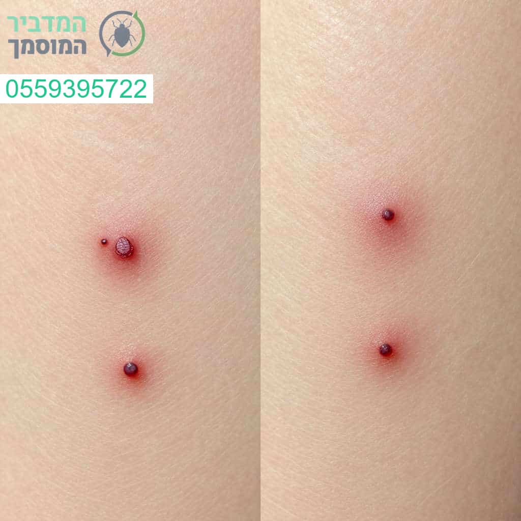 זיהוי והבחנה מקצועית בין עקיצות פרעושים לעקיצות פשפש המיטה למניעה ופתרון יעיל