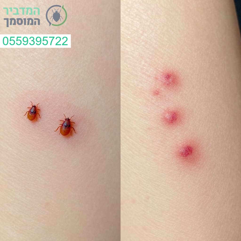 זיהוי מדויק והבחנה מהירה בין עקיצות פרעושים לעקיצות פשפש המיטה